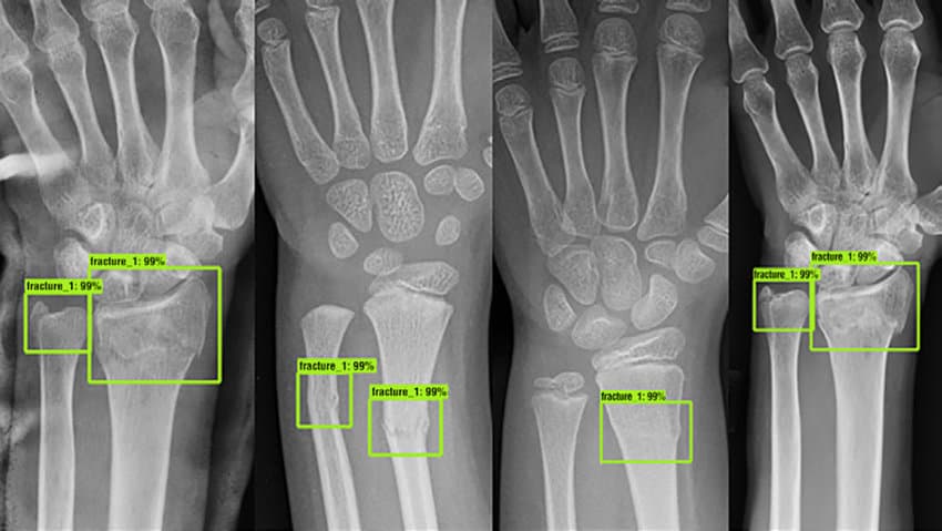 fracture ai