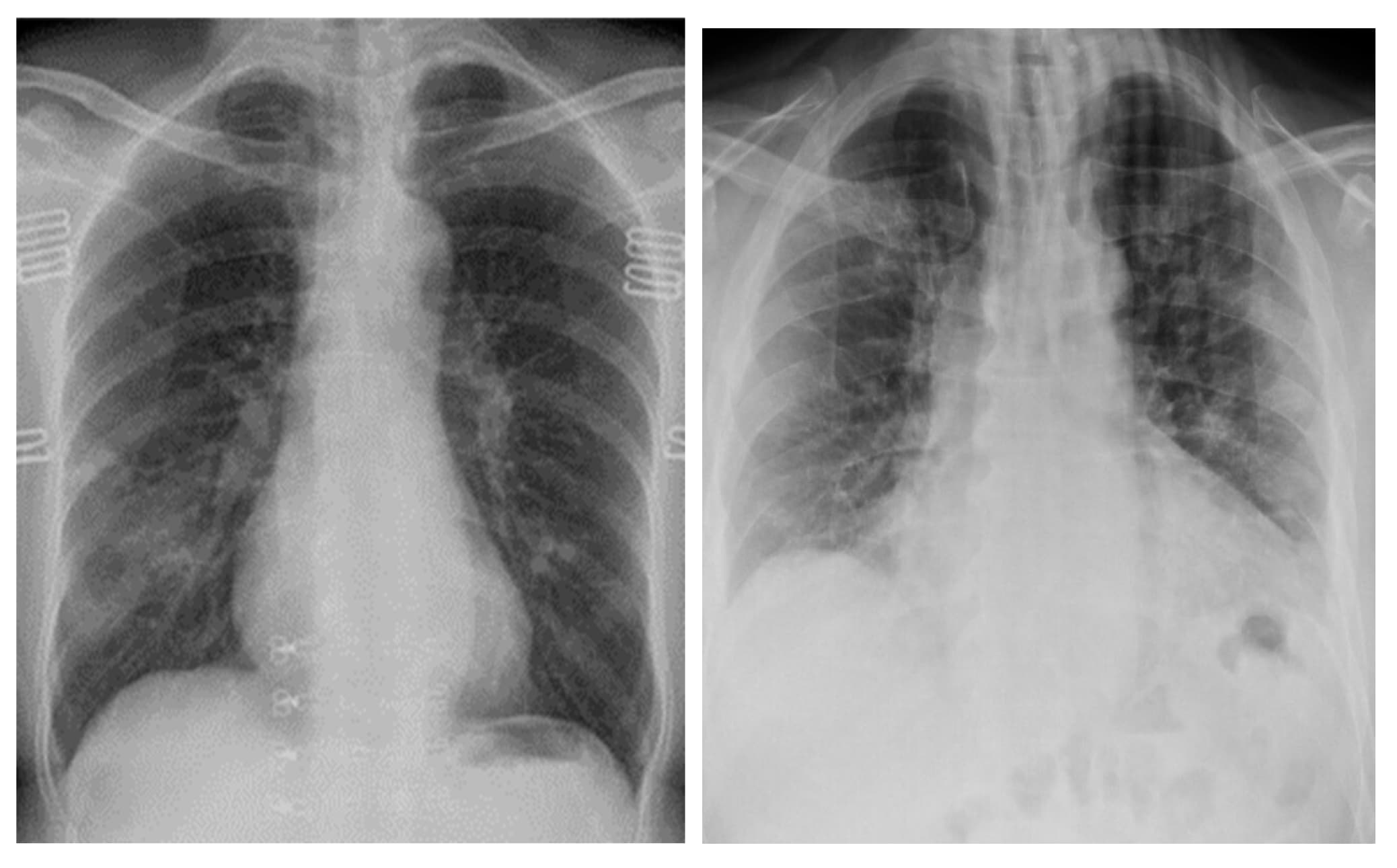 xray gan